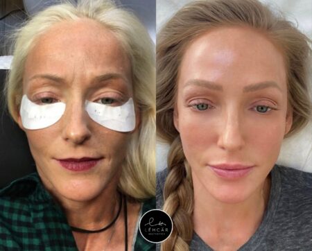 After years of sun abuse, and then getting chronically ill, I had my very own skin transformation.